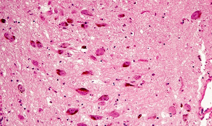 Image: Micrograph of human brain showing signs of Parkinson’s disease (Photo courtesy of Michael Abbey / SPL).